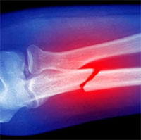 Nghiên cứu thử nghiệm dùng công nghệ vaccine để chữa lành xương