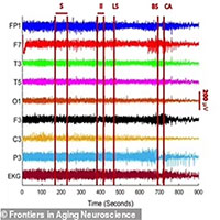 Lần đầu tiên ghi được sóng não của người chết, hé lộ sự thật khủng khiếp