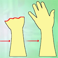 Liệu pháp tế bào gốc kết hợp sóng âm có thể giúp xương gãy mọc trở lại