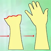 Liệu pháp tế bào gốc kết hợp sóng âm có thể giúp xương gãy mọc trở lại