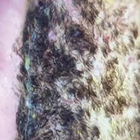 Đã tìm ra nguyên nhân tại sao lưỡi có lông đen