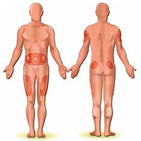 Tại sao một số mũi được tiêm vào tay, một số mũi khác được tiêm vào mông?