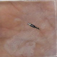 Chế tạo robot siêu nhỏ giúp điều trị khối u