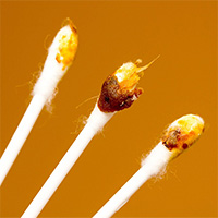 Ráy tai như thế nào là bình thường?