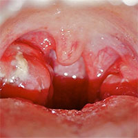 Nguyên tắc vàng để trẻ không gặp nguy hiểm khi viêm họng