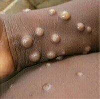 Phát hiện chủng virus đậu mùa khỉ thứ hai đang lây lan nhanh