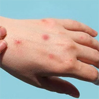 Rác thải y tế có thể khiến virus bệnh đậu mùa khỉ lây lan