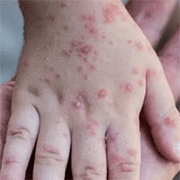 Bệnh đậu mùa khỉ có khả năng dự phòng bằng vaccine đậu mùa không?