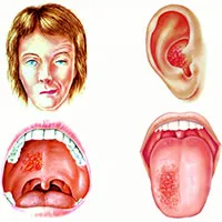 Hội chứng Ramsay Hunt là gì?