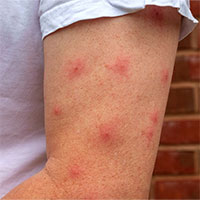 Cùng ở một chỗ, vì sao có người bị muỗi chích nhiều, người thì không?