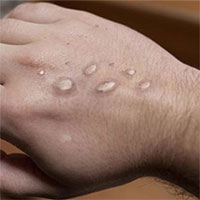 Singapore xác nhận trường hợp nhiễm bệnh đậu mùa khỉ đầu tiên