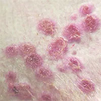 Ba triệu chứng nặng cần lưu ý của bệnh đậu mùa khỉ