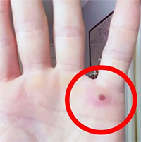 Phân biệt nốt phát ban đậu mùa khỉ với bệnh về da khác