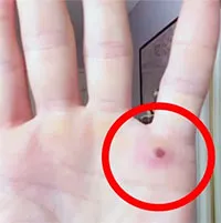 Phân biệt nốt phát ban đậu mùa khỉ với bệnh về da khác