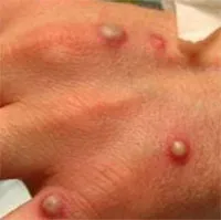 Bộ Y tế ban hành hướng dẫn chẩn đoán, điều trị và phòng bệnh đậu mùa khỉ