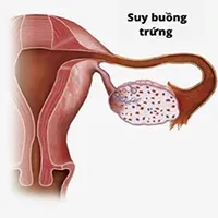 Suy buồng trứng nguyên phát là gì?