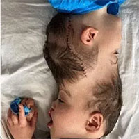 Dùng công nghệ thực tế ảo, các bác sĩ phẫu thuật tại Anh và Brazil tách đầu thành công cặp song sinh dính liền