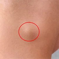 Bệnh lao hạch: Nguyên nhân, triệu chứng và cách điều trị