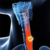 Những thủ phạm gây ung thư thực quản bạn không ngờ tới