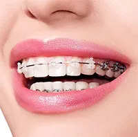 Lịch sử chỉnh nha, niềng răng và những bí mật thú vị ít người biết