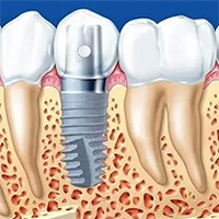Lịch sử ra đời và phát triển của những chiếc răng giả