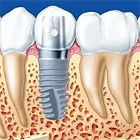 Lịch sử ra đời và phát triển của những chiếc răng giả