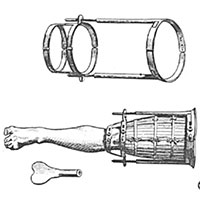 Người xưa làm thế nào để chữa gãy xương?