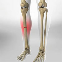 Phát hiện tế bào gốc giúp sửa chữa các chấn thương xương