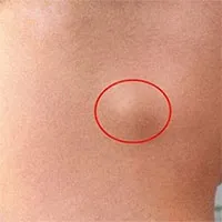 Sưng hạch bạch huyết là gì?
