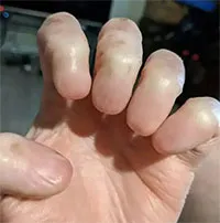"Dị nhân" tay không có móng, không dấu vân tay
