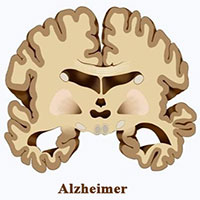 Nghiên cứu cho thấy: Có thể mắc bệnh Alzheimer vì ngoáy mũi