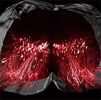 Truyền điện bằng phương pháp đột phá, 9 người bị liệt đi lại được