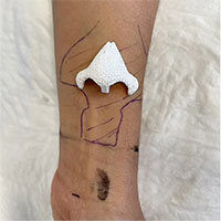 Chiếc mũi nhân tạo được 