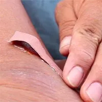 Cách xử lý vết thương có nguy cơ nhiễm vi trùng uốn ván