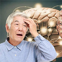 Bệnh Alzheimer là gì?