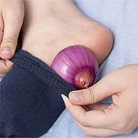Bỏ hành tây vào tất và đi qua đêm có giúp điều trị bệnh cúm không?