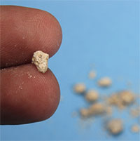 Tại sao bạn vẫn đau sau khi sỏi thận đào thải?