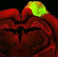 Đột phá mới trong việc cấy ghép mô não