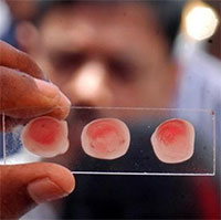 Nhóm máu có nguy cơ mắc bệnh tim cao nhất