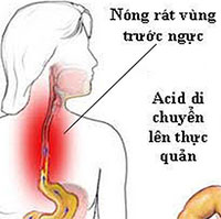 Mẹo ăn uống hạn chế triệu chứng khó chịu, người bị trào ngược dạ dày - thực quản nên biết