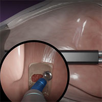 Công ty công nghệ Israel phát triển robot y tế phẫu thuật não nhỏ như cây bút