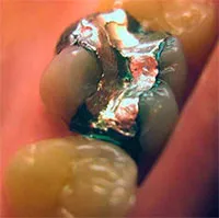 "Bệnh dịch" răng nổ kỳ lạ vào thế kỷ 19