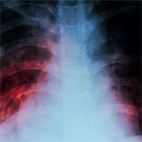 WHO cảnh báo: Một 