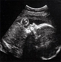 Phẫu thuật thành công một bào thai mắc dị tật hiếm ở não