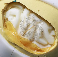 Điện cực hình bông hoa mở ra khả năng phẫu thuật não điều trị thần kinh với xâm lấn tối thiểu