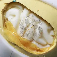 Điện cực hình bông hoa mở ra khả năng phẫu thuật não điều trị thần kinh với xâm lấn tối thiểu