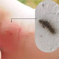 Phát ban do sâu bướm: Cách phát hiện và điều trị