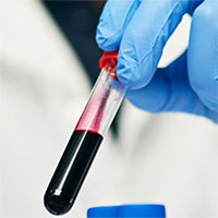 Dấu hiệu trong máu báo trước việc sa sút trí tuệ hàng chục năm sau