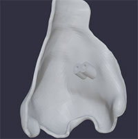 Mũi in 3D dành cho các bệnh nhân ung thư ở Singapore