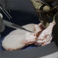 Cấy ghép thành công thận lợn đột biến gene cho bệnh nhân chết não